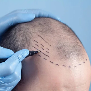 hair_transplant