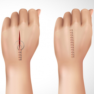 Hand_Nurve Surgery