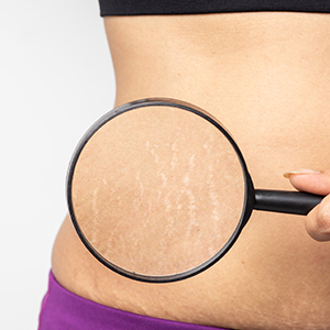 Scar Correction